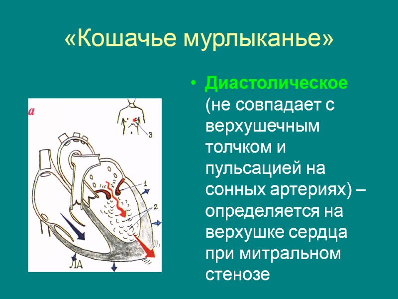 «Кошачье мурлыканье» Диастолическое (не совпадает с верхушечным толчком и пульсацией на сонных артериях) –